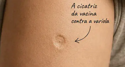 A pequena cicatriz no braço que marcou uma das maiores vitórias da humanidade